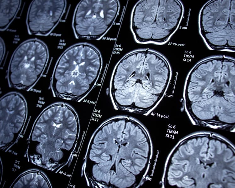 Commentary: The middle-aged brain changes a lot - and is key to understanding dementia