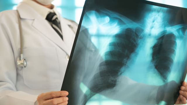 马国柔佛笨珍一小学生感染肺结核