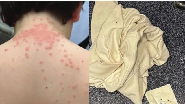 疑飞机上有臭虫 美国一家四口出现皮疹起诉荷兰皇家航空