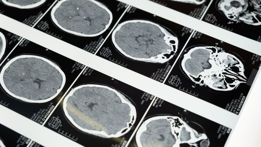 Masalah otak didapati pada 1% pesakit COVID-19 di hospital Masalah otak didapati pada 1% pesakit COVID-19 di hospital