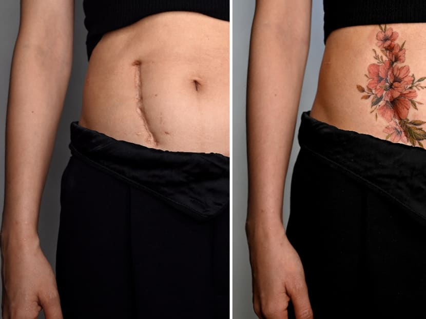 A female customer's post-surgery scar before (left) and after a tattoo procedure at tattoo artist Ngoc Like's studio in Hanoi, Vietnam on March 20, 2021.