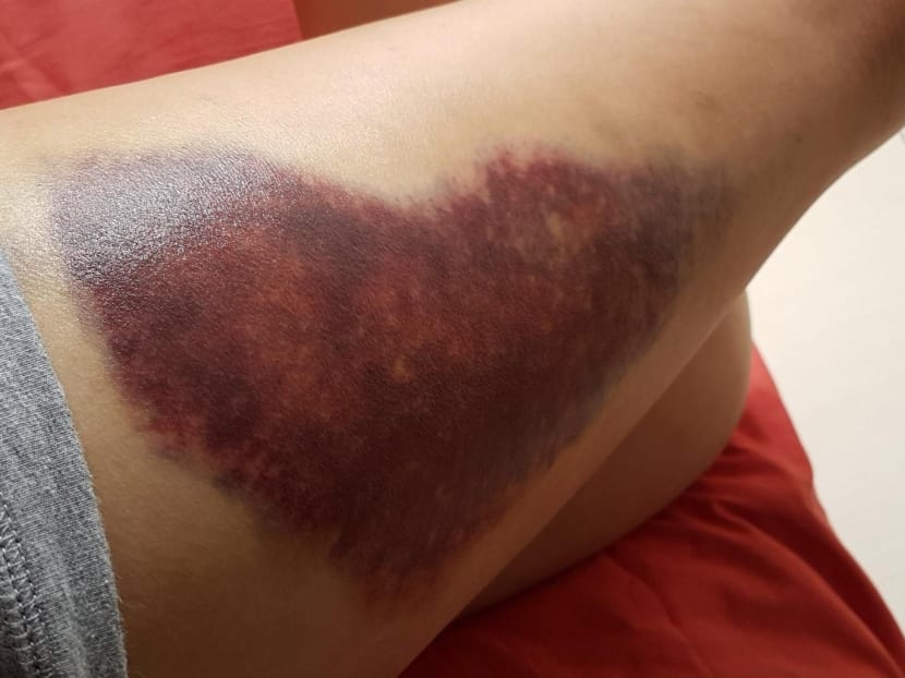 Finance professional Ms Koh, 25, suffered a large bruise to her left thigh after her leg was caught in the gap between the train and the platform at City Hall MRT station on Oct 25 2017. Photo: Ms Koh