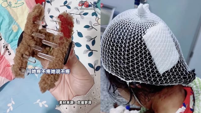 戴鲨鱼发夹摔倒刮破头皮 中国女孩缝三针