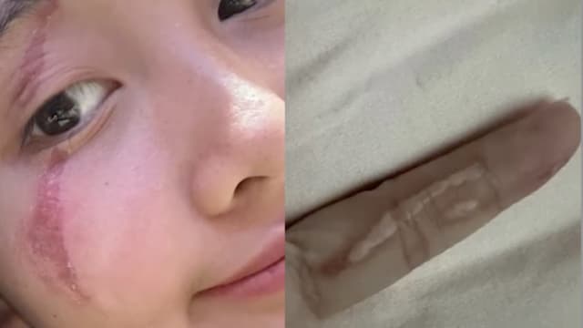 随手拍死隐翅虫 中国女子脸红肿险毁容