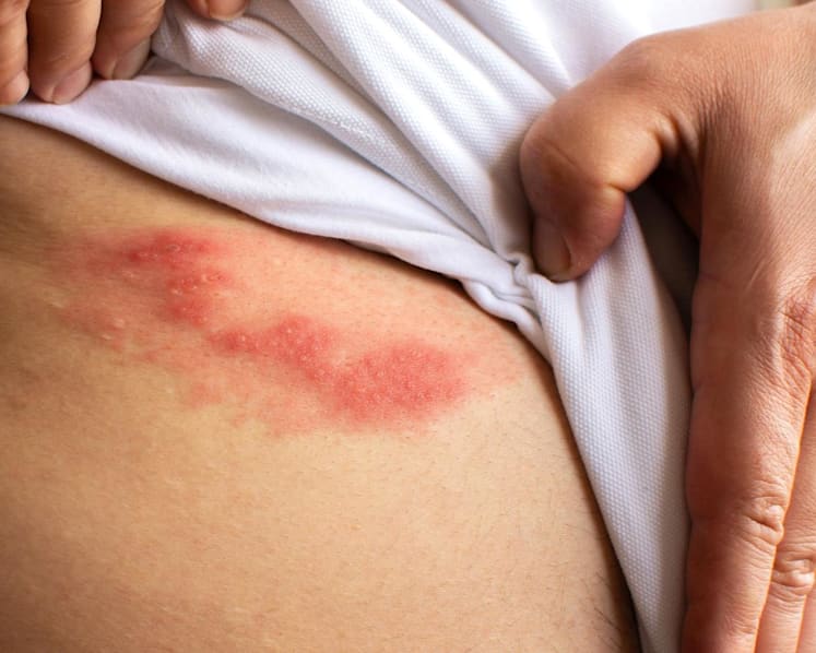 Shingles: More than a rash, a painful condition not to ignore 