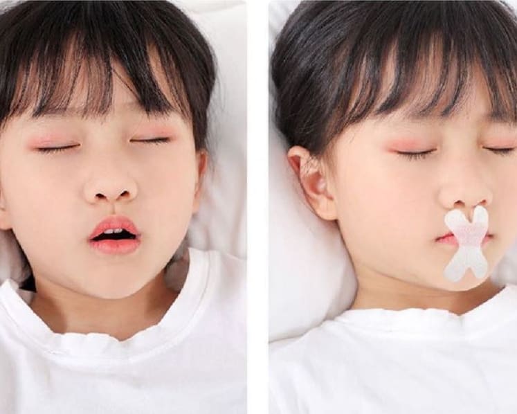 Singapore authorities to look into sale of mouth breathing tapes, head shaping helmets for children