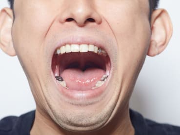 You could start losing teeth in your 30s – how to keep the rest of them before it’s too late