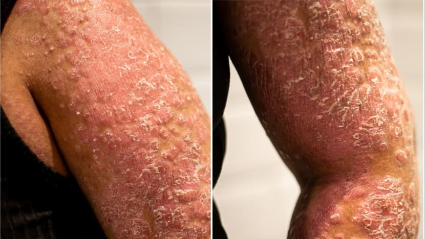 ‘Smells like rotten fish, feels like a curse’: Pain, odour and isolation for people with rare skin disease 