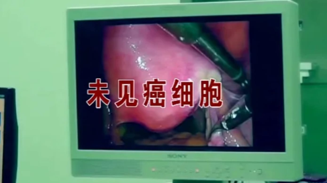 武汉男子被误诊胃癌切除全胃 法院判医院疏失须赔逾4万新元