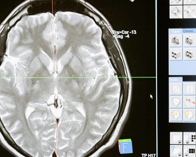 Commentary: Even mild cases of COVID-19 might be bad for our brains