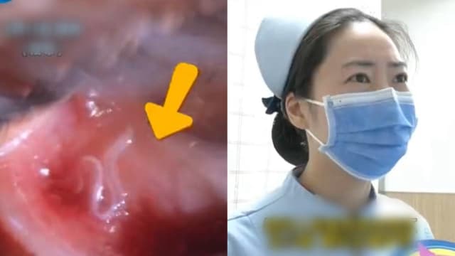 疑摸宠物没洗手 中国女子眼里发现白色虫子
