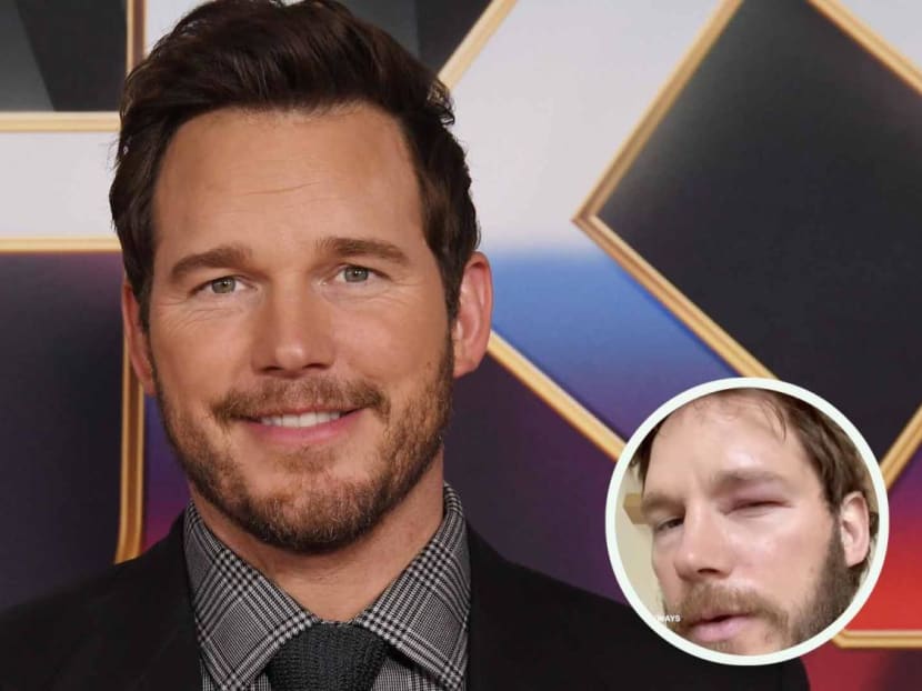 Chris Pratt Stung In Eye By Bee After Watching Viral Bee Lady: "I Think I Can Control Bees, Too"