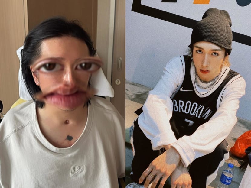 Hong Kong dancer injured during 2022 Mirror concert uploads first photo of face since accident