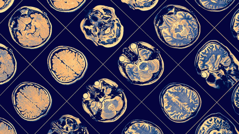 Singapore researchers identify two genes associated with risk of schizophrenia Singapore researchers identify two genes associated with risk of schizophrenia