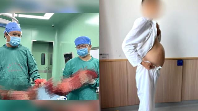 中国男子便秘四个月　医生手术取出两米长“蟒蛇肠”
