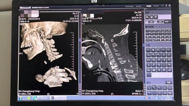 工人颈椎严重脱位“身首离断”  上海医生成功完成罕见手术