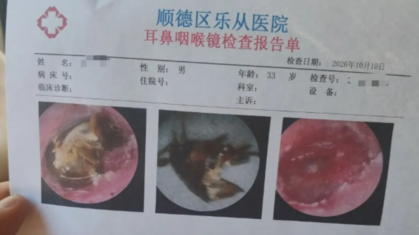 蟑螂钻耳男子自行冲水 隔近一周就医耳膜险穿孔