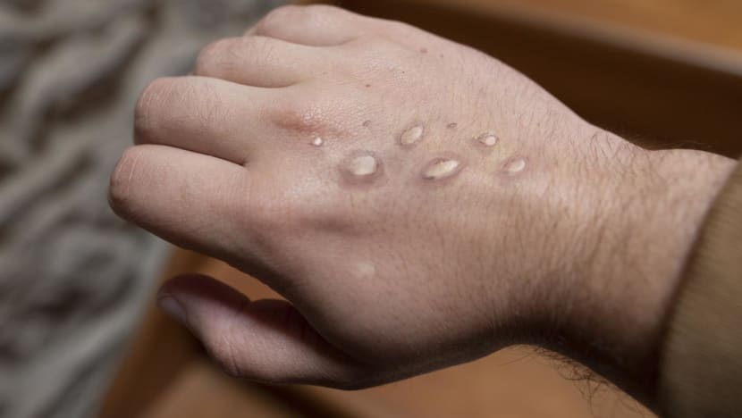 Not a surprise if Singapore detects monkeypox case in coming weeks: Ong Ye Kung Not a surprise if Singapore detects monkeypox case in coming weeks: Ong Ye Kung