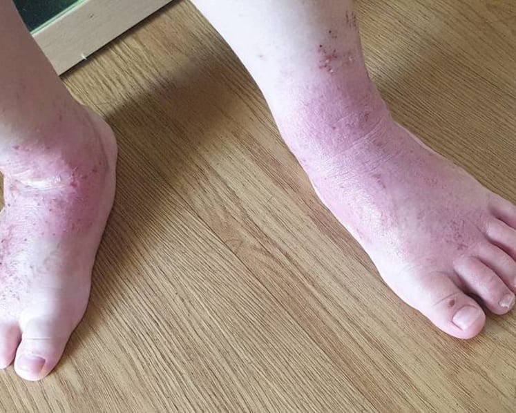 Infant eczema: Genes play a role but symptoms can be controlled, doctors say