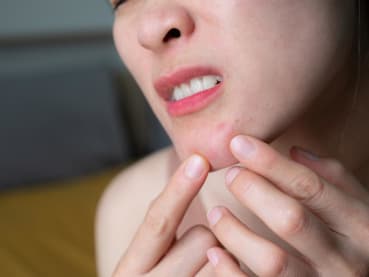 What is hormonal acne and why do some women battle it into adulthood?