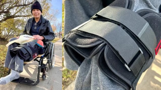 加拿大男子右腿感染需切除 手术后醒来惊觉医生切左腿