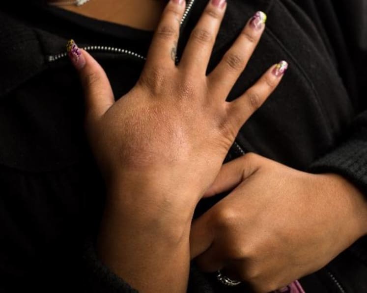Commentary: Low self-esteem, depression and frequent flare-ups plague growing numbers of eczema sufferers