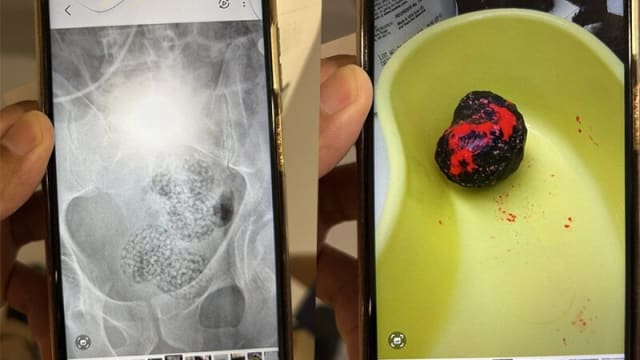 在泰国机场癫痫发作送院 奥男肠内发现大批颗冰毒