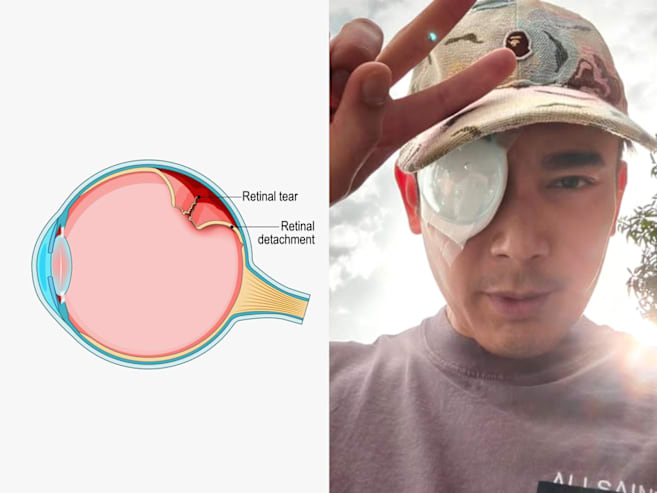 Elvin Ng’s eye surgery: Retinal detachment, myopia and the warning signs you should not ignore