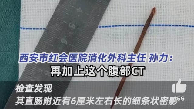 中国男子左腿痛十几年 原因竟是误吞牙签 