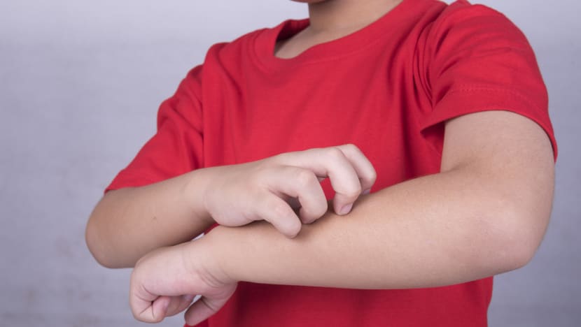 The hidden price of childhood eczema