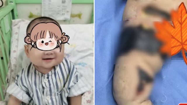 被虫咬导致器官衰竭 中国女婴全身换血保命