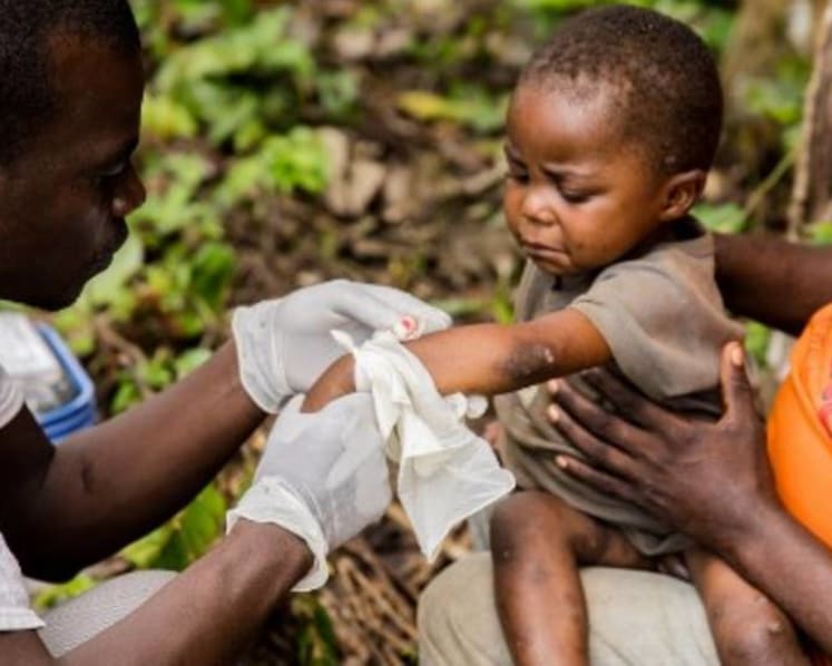 First monkeypox case in Singapore: What you need to know about the disease