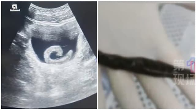 轻信网络偏方 中国男子把活体水蛭塞入尿道险酿大祸