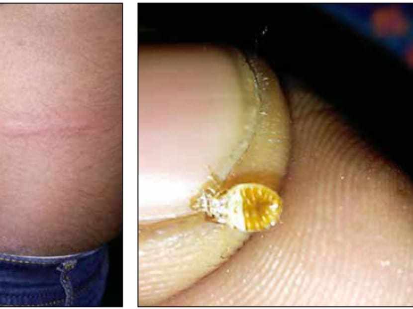Mr Yuvaraj Sivanathan showing the bites he suffered (left) and said he found at least two bedbugs (right) on his seat about half an hour into the journey from Kuala Lumpur to Singapore on Jan 11, 2017. Photo: Yuvaraj Sivanathan