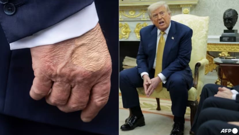 Trump didiagnos alami masalah salur darah kronik selepas kaki bengkak, tangan lebam Trump didiagnos alami masalah salur darah kronik selepas kaki bengkak, tangan lebam
