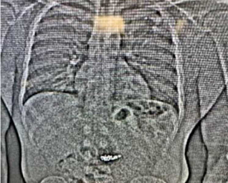 X-ray shows US$770,000 diamond earrings swallowed by theft suspect during arrest: US police