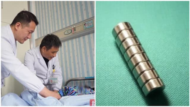中国七岁男童用磁铁夹伤生殖器险致坏死