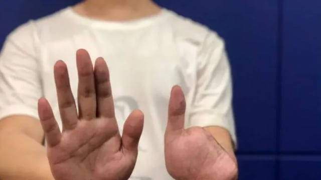 赴缅淘金却换来噩梦 华男拒行骗遭“活斩四指”