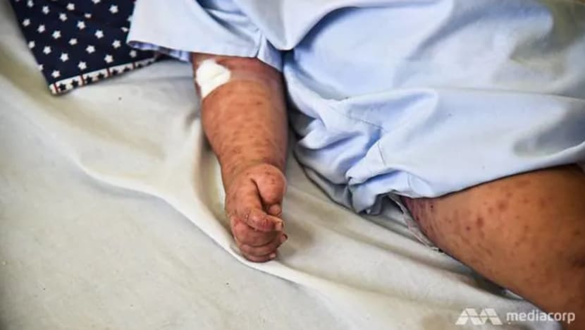 Kes campak di S'pura cecah 149 di tengah-tengah peningkatan global