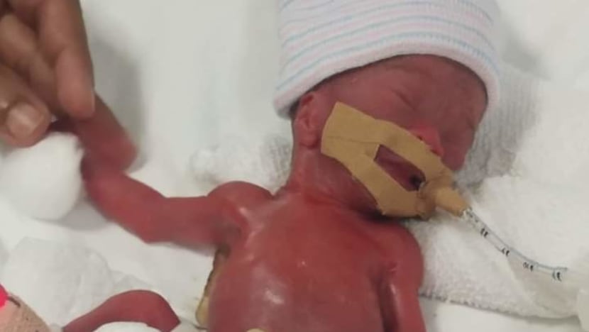 World’s smallest baby, born at 212 grams at NUH, now doing well at 14 months old