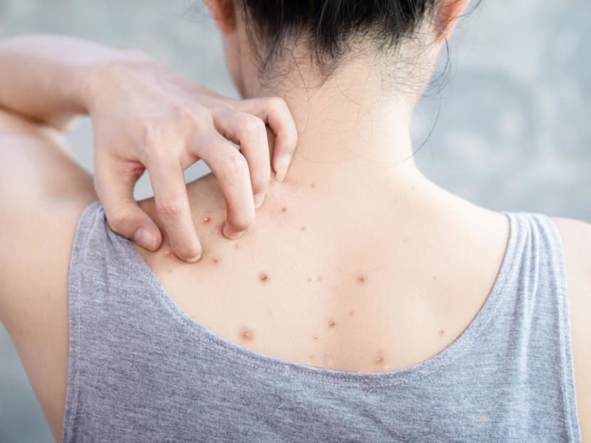 Dealing with 'bacne': What causes body and back acne and how to treat it Dealing with 'bacne': What causes body and back acne and how to treat it