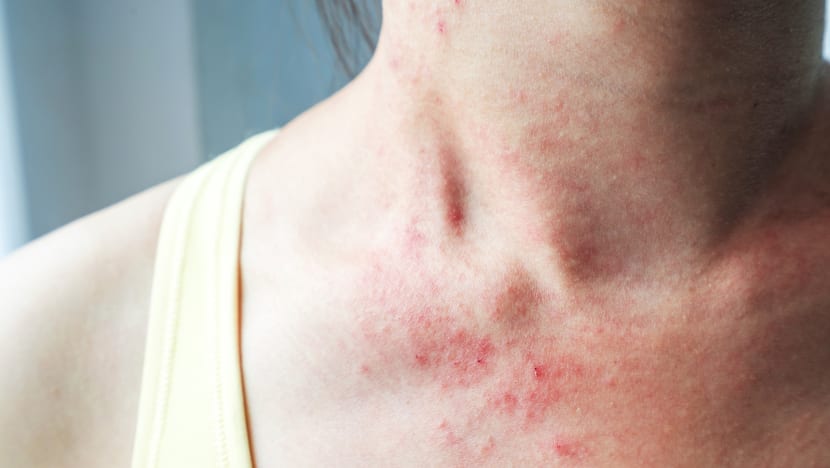 Living with severe eczema: Lost sleep, blood on clothes, mental health struggles