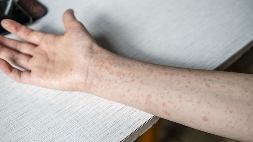 Singapore's measles cases reach six-year high, three vaccinated cases among 40 infections