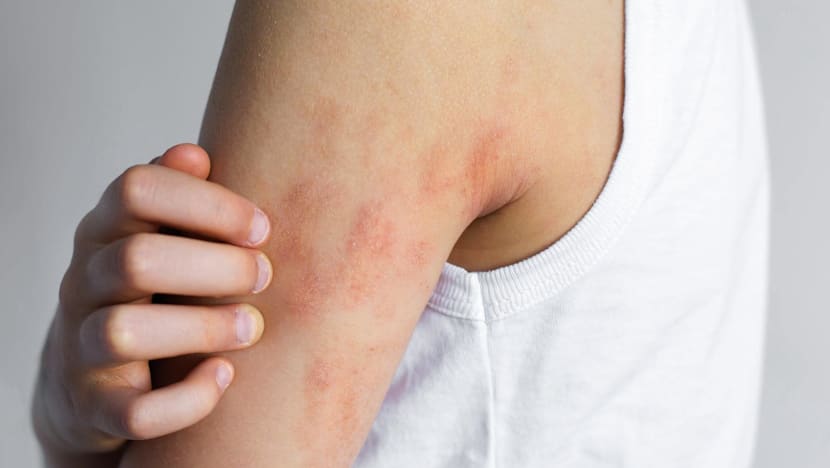 New eczema treatments available in Singapore, but high costs keep them out of reach