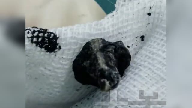 中国七岁男孩鼻腔闻臭味两年 医生竟取出螺丝钉