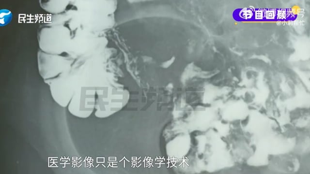 中国男孩开刀五年后阑尾还在 父亲：当时割的是什么