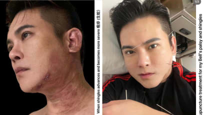 “My Doctor Says I Can't Return To Acting… Unless I Play A Stroke Victim”: Ex Mediacorp Actor Nick Shen On Getting Shingles And Then Bell’s Palsy