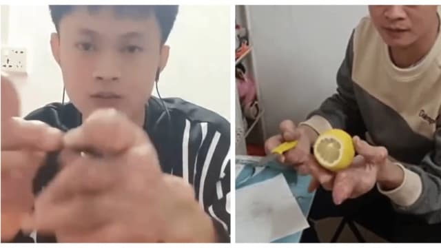 中国男子把汽水奶茶当水喝 双手变形像生姜