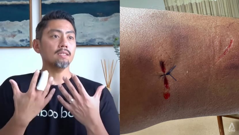 ‘I couldn’t feel my finger’: Sentosa Cove resident needed 3-hour surgery after otter attack ‘I couldn’t feel my finger’: Sentosa Cove resident needed 3-hour surgery after otter attack