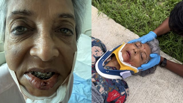 老妇遭个人代步工具后方撞击 脸朝下撞路面下巴骨折